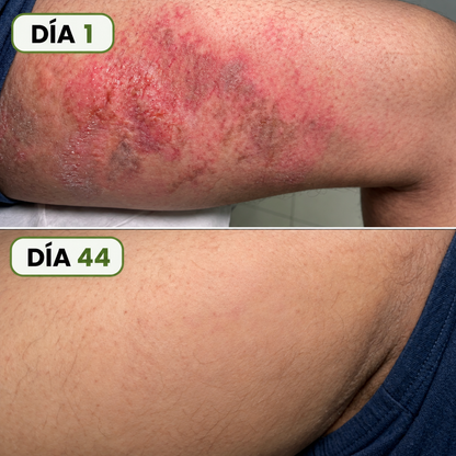 Bartila - Crema de Cuidado Para los Pliegues de la Piel